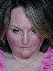 Facial Fat Transfer Before & After