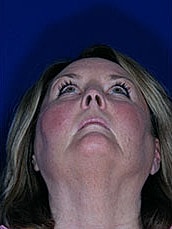 Facial Fat Transfer Before & After