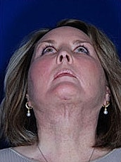Facial Fat Transfer Before & After