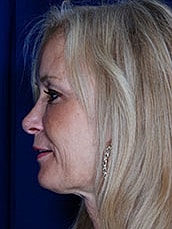 Facial Fat Transfer Before & After