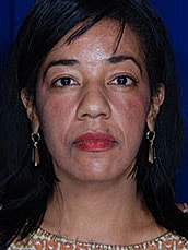 Facial Fat Transfer Before & After