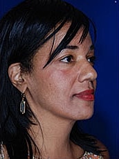 Facial Fat Transfer Before & After