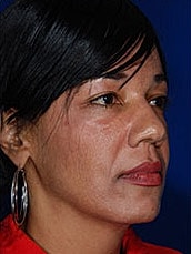 Facial Fat Transfer Before & After