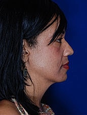 Facial Fat Transfer Before & After
