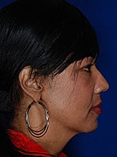 Facial Fat Transfer Before & After