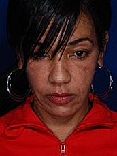 Facial Fat Transfer Before & After