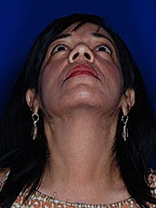 Facial Fat Transfer Before & After