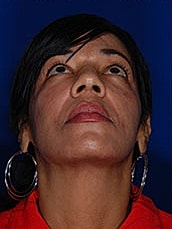 Facial Fat Transfer Before & After
