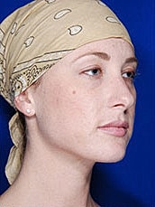 Facial Fat Transfer Before & After