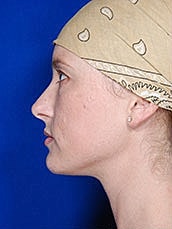 Facial Fat Transfer Before & After