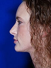Facial Fat Transfer Before & After