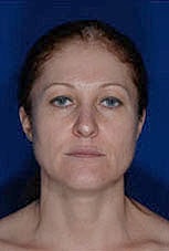 Facial Fat Transfer Before & After