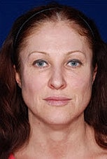 Facial Fat Transfer Before & After