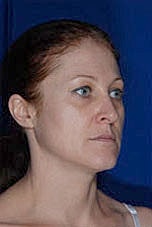 Facial Fat Transfer Before & After