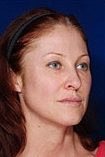Facial Fat Transfer Before & After
