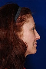 Facial Fat Transfer Before & After
