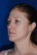 Facial Fat Transfer Before & After