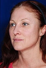 Facial Fat Transfer Before & After