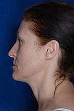 Facial Fat Transfer Before & After