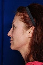 Facial Fat Transfer Before & After