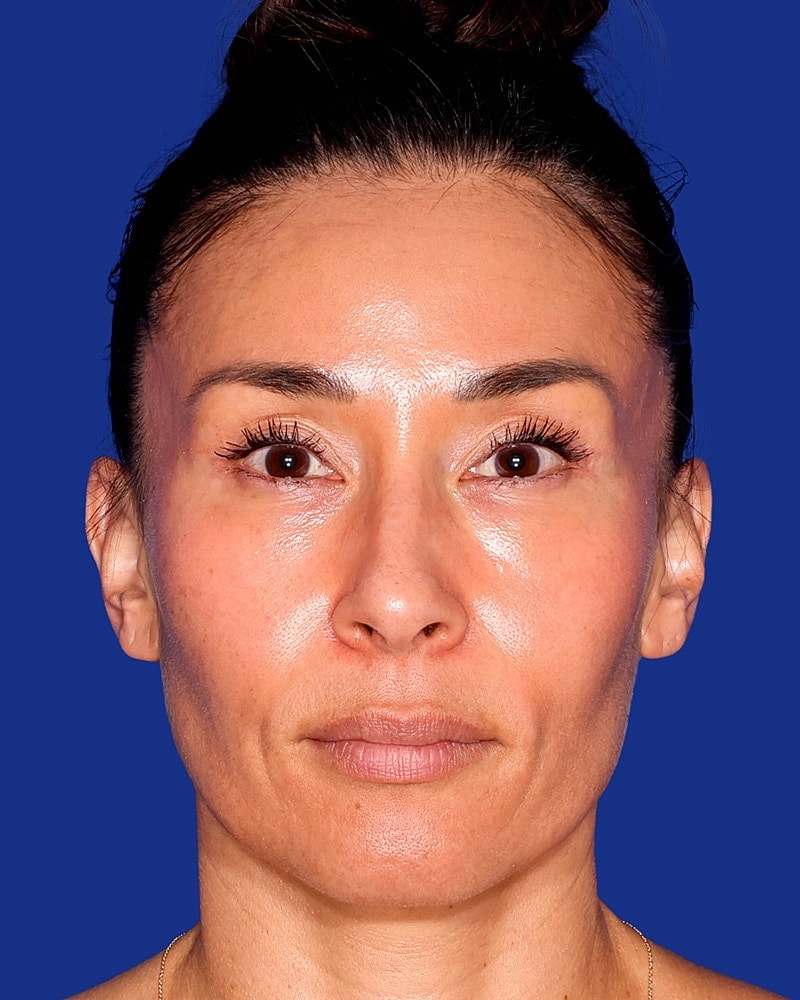 Facial Fat Transfer Before & After