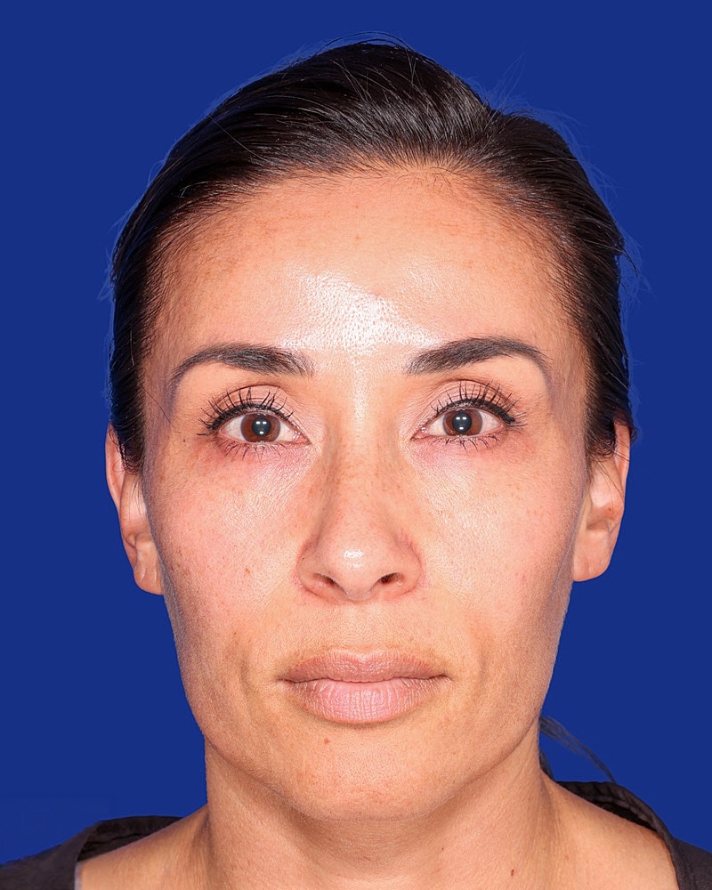 Facial Fat Transfer Before & After