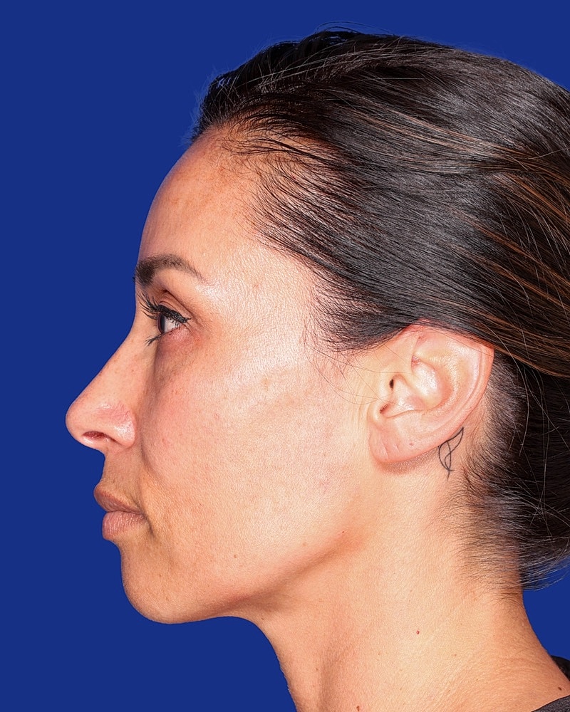 Facial Fat Transfer Before & After