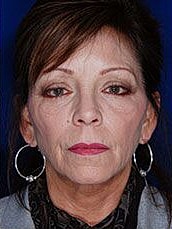 Facial Fat Transfer Before & After