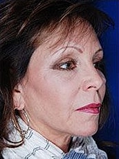 Facial Fat Transfer Before & After