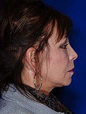 Facial Fat Transfer Before & After