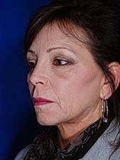 Facial Fat Transfer Before & After
