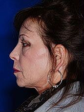 Facial Fat Transfer Before & After