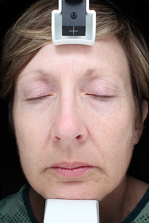 Facial Fat Transfer Before & After