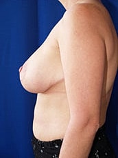 Breast Reduction Before & After