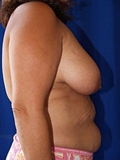Breast Reduction Before & After