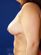 Breast Reduction Before & After
