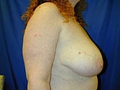 Breast Reduction Before & After