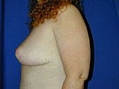 Breast Reduction Before & After