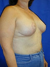 Breast Reduction Before & After