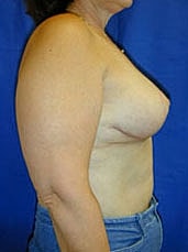 Breast Reduction Before & After