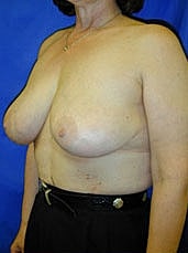 Breast Reduction Before & After