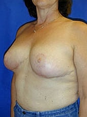 Breast Reduction Before & After