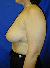 Breast Reduction Before & After