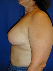Breast Reduction Before & After