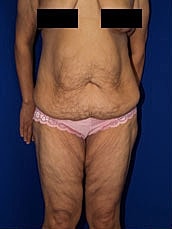 Body Lift Before & After