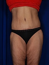 Body Lift Before & After