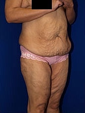 Body Lift Before & After