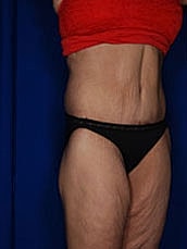 Body Lift Before & After