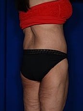 Body Lift Before & After