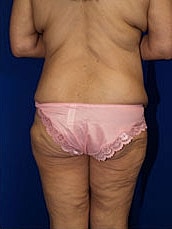Body Lift Before & After